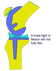 dur'g TKA trial; knee is stable at full extension, but it will not flex past 90 deg. Which adjustments can achieve satisfactory ROM & stability flex/ext? 1-Downsiz'g tib insert; 2-Placg pos fem augments; 3-Resectg more dis fem;