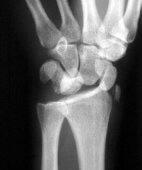 35yo professional football'er c/o severe wrist pn p/tackle. paresthesias thumb & index finger. AP & lat xrays fig A & B What next step in management? 1-SAC thumb spica; 2-LAC thumb spica; 3-urgent CR & splintg;