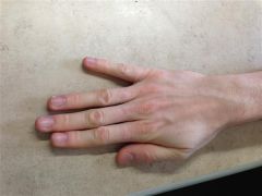 most predictive factors for correctly dxg (CTS)= abn hand diagram, abn sensibility by Semmes-Weinstein testg in wrist-neutral position, (+) Durkan's test, & night pain, the probability that carpal tunnel syndrome will be correctly dx'd is 0.86. 
...