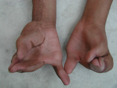 4yo child has flattened facial features, wide set eyes, and the hand deformity pictured in Fig A. Which of the following is the most likely diagnosis? 1-Apert's syndrm 2-Multiple epiphyseal dysplasia; 3-Cleidocranial dysplasia; 4-Noonan syndrm 5-A...