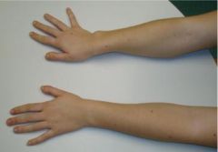 4-Impaired growth of the volar & ulnar aspect of the distal radial physis; 5-Unrecognized trauma::caused by impaired growth of the volar & ulnar aspect of the dist rads physis, bony lesion in the palmar/ulnar corner distl radl physis or an abn rad...