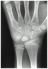 1-Radial clubhand; 2-scaphoid fx; 3-hypoplastic thumb; 
4-Gymnast’s wrist is a distal radius physeal injury due to repetitive axial loading; 5-keinbock's dz; which of the depicted conditions is temporary scaphotrapeziotrapezoidal pinning most i...