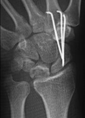 Temporary scaphotrapeziotrapezoidal (STT) pinning is indicated for treatment of Kienbocks disease in adolescents as shown in Figure D. The radiograph shows increased density and slight lunate collapse.Ans5