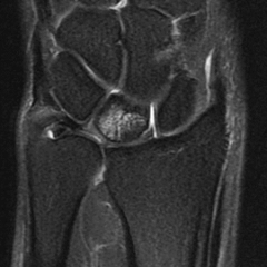 32 yo carpenter c/o progressvly worsn'g wrist pn: 2 mths duration. denies hx trauma-> wrist/hand.  MRI fig A. Which of the followg surgical interventions is thought to be effective for this condition by inciting a local vascular healing response?