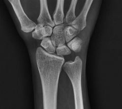 30yo F gets scopy chronically painful R wrist, faild to improve w/ 4 mths of immobilization & NSAIDS. PE: pnt tendrns dorsally over the lunate but no tendrns elsewhere. The articular surface of the lunate is stable to probing. Fig B & C. What is n...