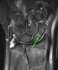 1-AP and lateral; scaphoid view-30 deg wrist extension, 20 degr ulnar dev; 45° pronation view; 2-thumb spica cast then repeat in 14-21 Dz; 3-@ 72 hr bn scan; 4-w/in 24 hrs; 5-1mm cuts CT progression of nonunion or union after surgery: distal-wais...