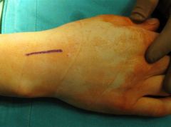 what is the indication of dorsal approach and volar approach to scaphoid fx? adv of each