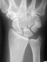 30yo F c/o 5 mths wrist pn  p/ fall onto wrist. in Fig A. If untreated, all of the following degenerative changes may be observed EXCEPT? 1-radial styloid osteophyte;
2-radioscaphoid DJD; 3-midcarpal DJD; 4-pancarpal DJD 
5-radiolunate DJD
