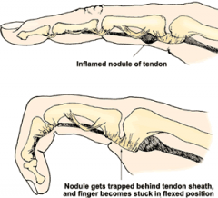 1- Extensor digitorum T; 2-Grayson's lig; 3-Oblique retinacular lig; 4-A1 pulley; 5-Transverse carpal lig:::MC'ly at the level of the 1st annular (A1) pulley, 2 corticosteroid injs given before surgery. DDx-collateral lig or volar plate tethers MC...