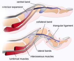 Rupture of the central slip of the extensor tendon & subsequent sublux of the lat bands grt boutonneire defrmty, which is PIP flex & DIP exten. rupture  terminal extensor T= mallet fingr. Sagittal band inj=  sublux exten tendn @ level MCP jnt. Chr...