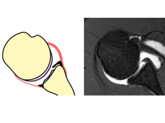 A GLAD lesion is a tear of the anterior inferior labrum (nondisplaced) with avulsion of the adjacent glenoid cartilage