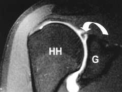 Superior labral tears anterior to posterior to the biceps root are known as SLAP tears (Illustration E) .