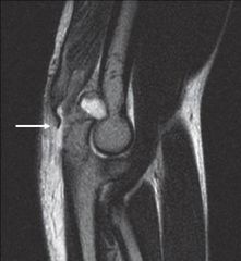 3 MRI  sagital view T1
triceps tear- 
-most common rupture at the insertion of medial or lateral head
-less frequently through muscle belly or musculotendinous junction