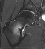 An MRI of femal long distance runner hip is shown:
Work-up should include evaluation for which of the following conditions