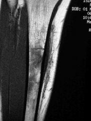tibia stress fracture
woman athlete have increased incidence of:
-patellofemoral disorders
-stress fractures 
-ACL injuries