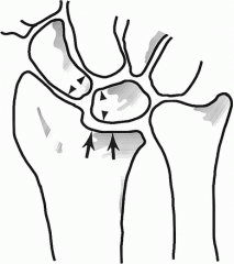 Die-punch fxs
A depressed fracture of the lunate fossa of the articular surface of the distal radius