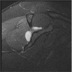 A patient is scheduled to undergo arthroscopy for a SLAP tear of his shoulder. Based on the MRI shown in Figure A, what additional physical exam finding is the patient likely to display?