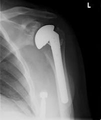 Which of the following factors has the greatest influence on early postopertive restrictions following total shoulder arthroplasty through a deltopectoral approach?