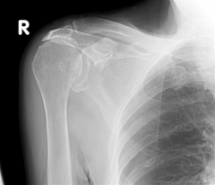 Rotator Cuff Arthropathy-
Radiographs
        recommended views  findings
    MRI