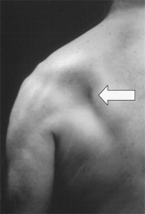 Entrapment of the suprascapular nerve at the spinoglenoid notch would cause isolated infraspinatus muscle weakness and atrophy in the infraspinatus fossa.