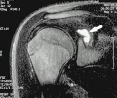 A patient with shoulder pain and weakness has an MRI showing a cyst in the suprascapular notch. Which of the following muscles is most likely to show weakness?