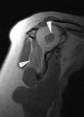 A-1Suprascapular notch entrapment
weakness of both supraspinatus and infraspinatus
spinoglenoid notch entrapment
 weakness of infraspinatus only