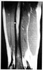 Once the radiographs show the fracture especially in the anterior cortex of the tibia, surgical treatment is often recommended. This location is uncommon, but at increased risk for nonunion and propagation to complete fracture.