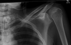 An acute posterior shoulder dislocation should be suspected in a patient with pain and the shoulder locked in what position?