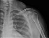 Posterior gleno-humeral dislocations are as common as anterior dislocations in which of the following patient groups?