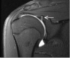 Posterior labral tear 
A football linemen has posterior shoulder pain after making a block with his arm in forward flexion and internal rotation. What is the most likely diagnosis?