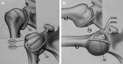 Which of the following is considered the primary static restraint to anterior gleno-humeral translation with the arm in 90 degrees of abduction?
the other star stabilizers, type of stabilizer?
