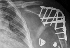 Which of the following patients would benefit most from a glenohumeral arthrodesis?