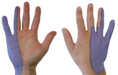 Ulnar tunnel syndrome: compression in Guyon’s Canal vs  Cubital Tunnel Syndrome difference sx
mcc ulnar tunnel syndrome?
causes of Ulnar tunnel syndrome? (star)