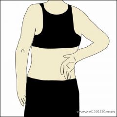 Subscapularis insufficiency 
Clinical findings include:
-internal rotation weakness, 
-increased passive external rotation, 
-weakness to belly press, and an 
-abnormal subscapularis lift-off test