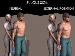 Sulcus Sign