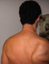 Lateral Scapular Winging