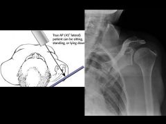 Grashey view	Glenohumeral joint space, DJD, and proximal migration of humerus