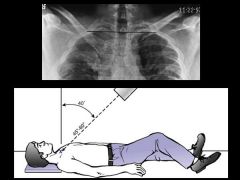 Anterior and posterior sternoclavicular dislocation