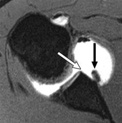 Anterior labral periosteal sleeve avulsion (ALPSA)