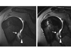 Humeral avulsion of the glenohumeral ligament (HAGL)