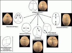 - Dolicocéphalie (sagittale)
- Brachycéphalie (coronales)
- Trigonocéphalie (métopique)
- Turricéphalie (lambdoïdes)
- Plagiocéphalie (coronale unilatérale)