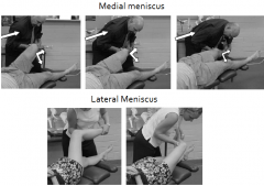 Displacement/ Minor tears of medial meniscus.
The foot and leg are externally rotated. VALGUS force, traction applied

Lateral meniscus- Contralateral, tibial internal rotation and adduction force (varus) combined with the traction.