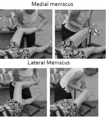 Displacement/ Minor tears of medial meniscus.
The foot and leg are externally rotated. VALGUS force, Thrust applied

Lateral meniscus- Contralateral, tibial internal rotation and adduction force (varus) combined with the thrust.