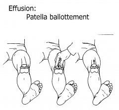 Push patella into joint and release suddenly patella seen to rise visibly. Positive test if patella slowly floats