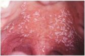 •	Clinical Information: 
o	This patient started a course of antibiotics 2 weeks ago.  He does not report having a fever or any other symptoms. Medical history includes asthma. The lesion is mildly symptomatic and wiped off with a q-tip swab. (P.H.P)
•	D