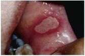 o	30 year old female. This patient has been experiencing very painful ulcers of multiple oral mucosal sites as long as she can remember. She now presents with the latest ulcer, which is so tender that it interferes with eating. It is the only such ulcer i