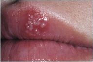 o	This patient just returned from a trip to the desert (and her first stop is at the dentist office?). She reports a tingling feeling about a day before this lesion appeared.  She also reports she kissed a camel that had Herpes Simplex Type 1 while in the
