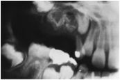 o	This male patient has lost his deciduous upper molars. The permanent premolars have not erupted. The radiograph shows permanent teeth present, but the enamel and dentin are very thin & indistinct.
o	Lesion looks (R.A.I.D.D.)
•	Description: 
o	Present