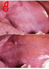 o	50 year old black female ($$90% in blacks!!) is worried about the white lesions on her cheeks. She heard that they could be pre-cancer (she heard wrong). Her health history is positive for hypertension treated with atenolol (bottom pic is stretched and 