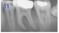 o	This patient reports that the area in the lower left has been tender for about 2 months. He is going through orthodontics. 
o	That a PERI G. RAD PERI A